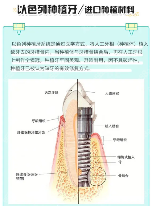 以色列雅定种植牙