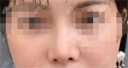 <!--<i data=20240705-sp></i>-->张亮做鼻子实例反馈