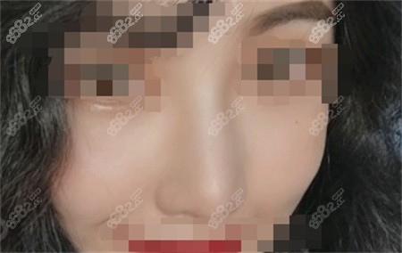 <!--<i data=20240705-sp></i>-->张亮做鼻子实例反馈