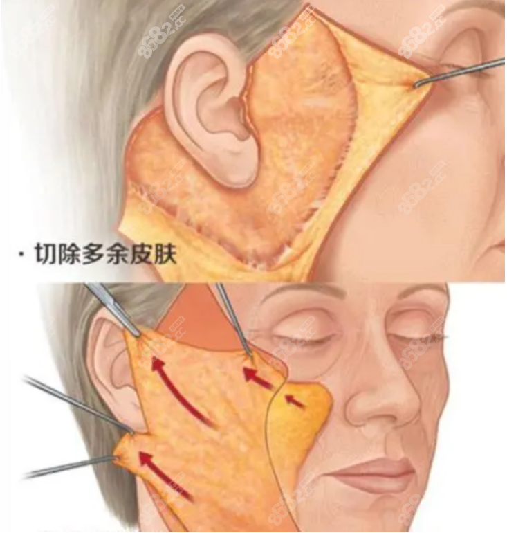 覃永喜医生拉皮怎么样