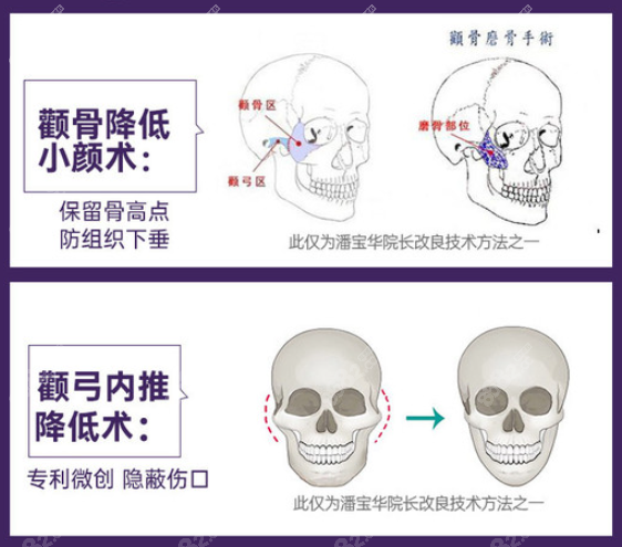 颧骨内推术后脸不下垂