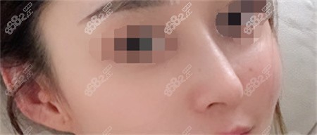 <!--<i data=20240705-sp></i>-->张亮做鼻子实例反馈