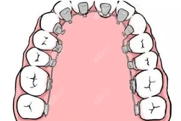 舌侧隐形矫正的卡通图