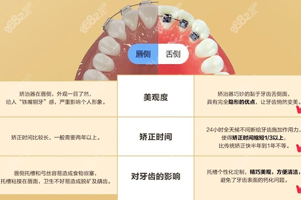 唇侧矫正和舌侧的对比图