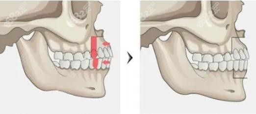 骨性凸嘴做正颌手术改善变化