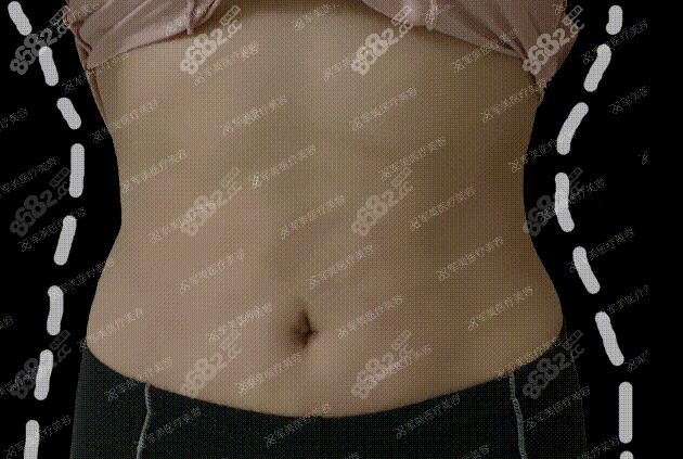王世虎吸脂术后照片