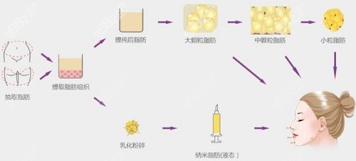 王世虎脂肪填充流程