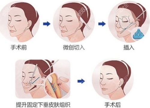 上海九院拉皮手术流程介绍