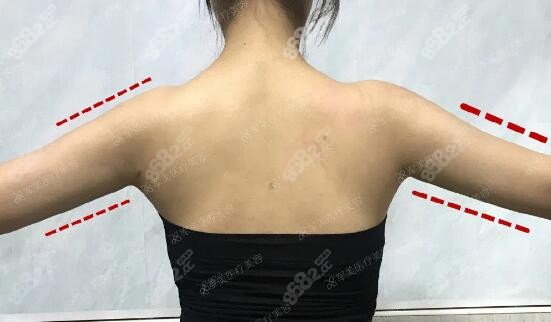 王世虎吸脂术后照片