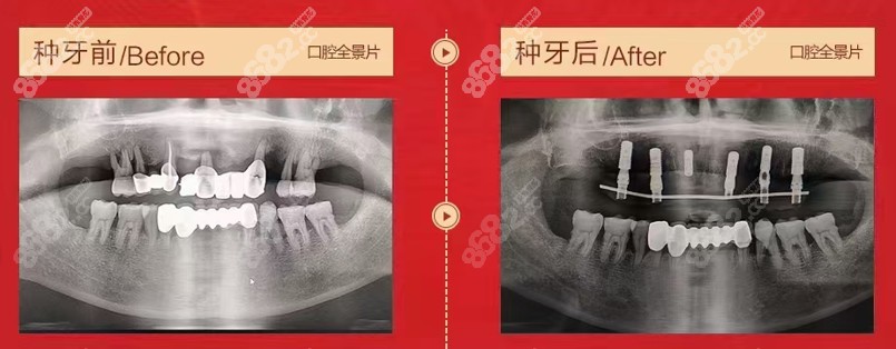 壹颗芽刘建明院长即刻负重种植牙前后种植对比图