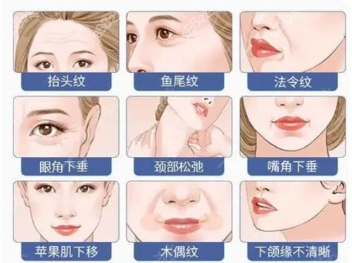 小切口拉皮能改善的部位