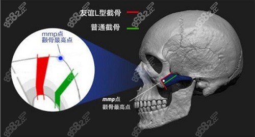 张立天颧骨颧弓截骨术式