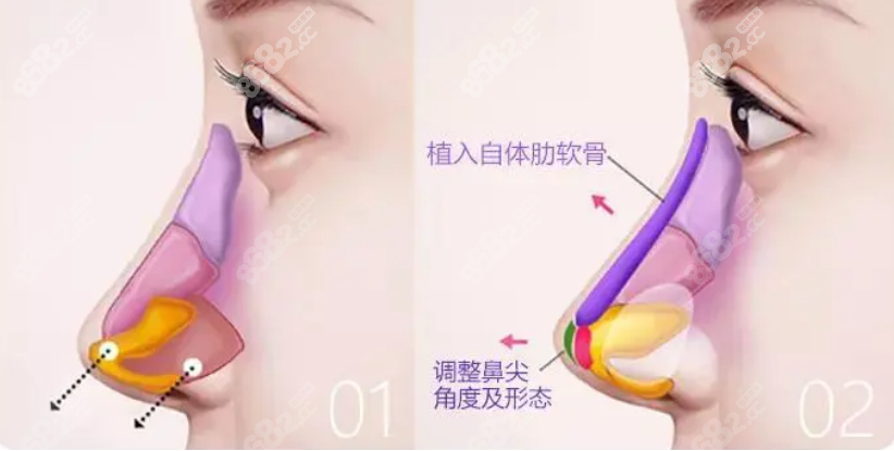 覃永喜醫(yī)生做鼻子的技術(shù)優(yōu)勢(shì)