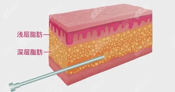 上海华美大腿分层吸脂