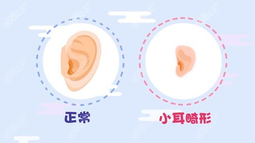 小耳畸形和正常耳朵区别