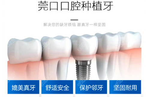 莞口口腔种植牙优势