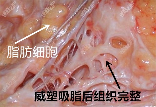 威塑吸脂技术图