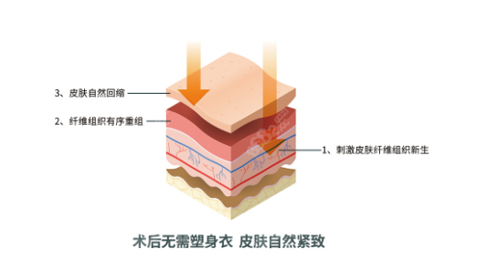 土麦森吸脂技术不需要穿塑身衣