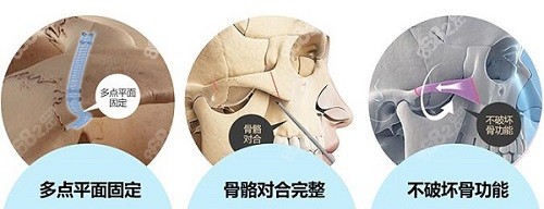 邱立东截骨术式