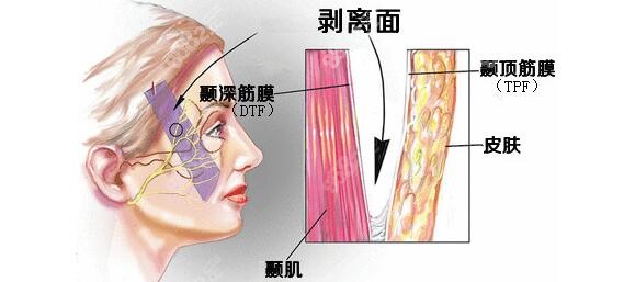 杨大平面部提升原理