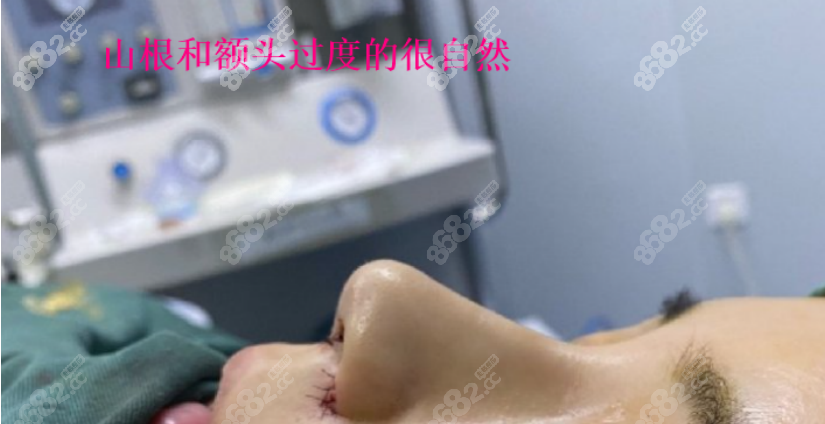 覃永喜做鼻子