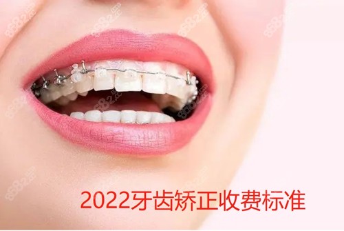 2022牙齿矫正收费标准
