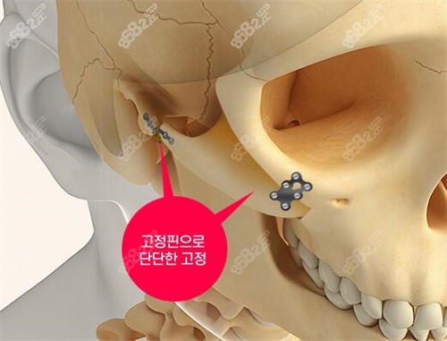 韩国1%整形颧骨固定