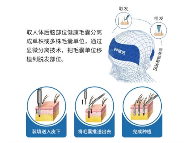 合肥曙光植发