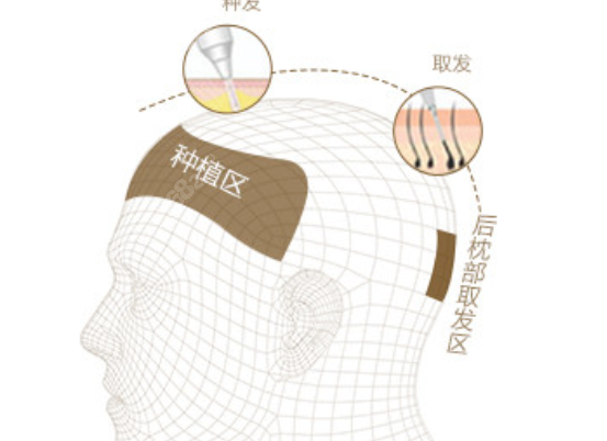 长沙笙泽植发方式