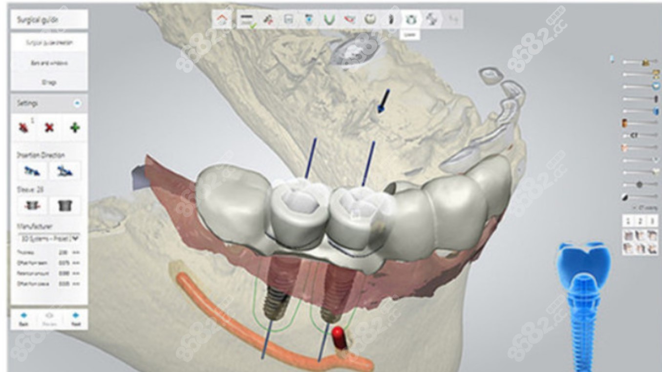 团圆口腔数字化种植牙技术