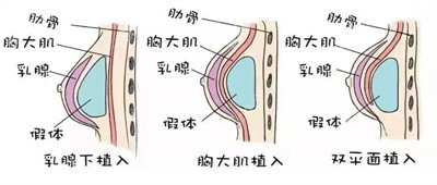 陈柳艺医生做深V动感隆胸手术的技术优势1