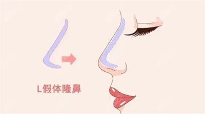 重庆美莱李任医生隆鼻的收费标准