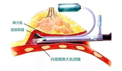 陈柳艺医生做深V动感隆胸手术的技术优势2