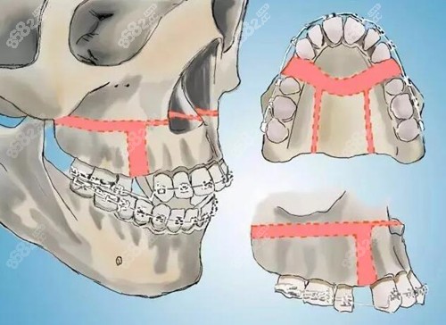 正颌手术的原理
