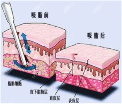 文杰医生抽脂的技术优势2