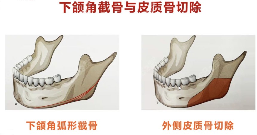 做下颌角截骨与皮质骨切除