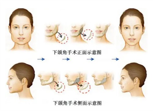 磨骨医生朱石江下颌角整形