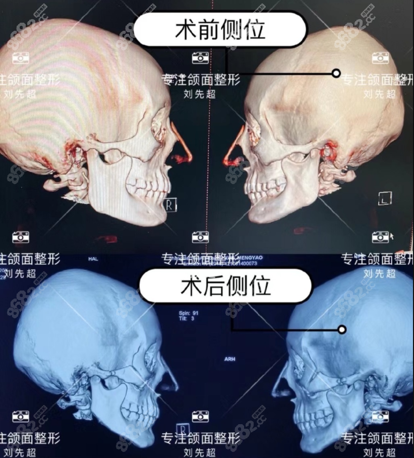 刘先超削下颌角对比照