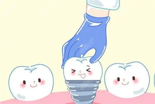 <!--<i data=20240705-sp></i>-->口腔种植牙真不赖