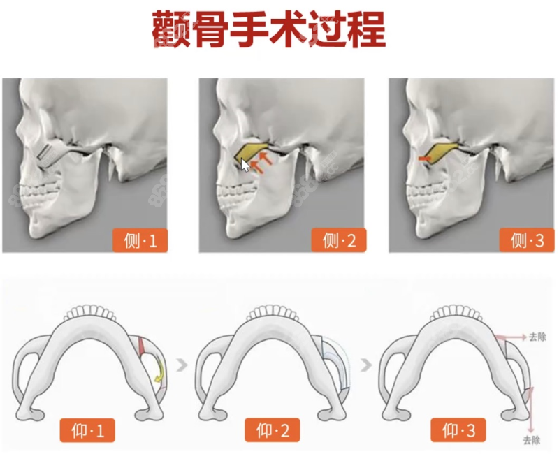 颧骨手术做得怎么样