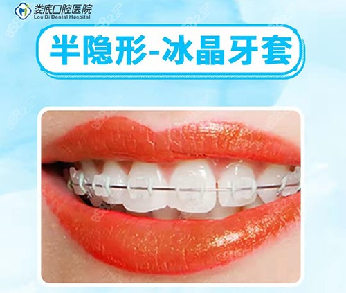 半隐形冰晶牙套