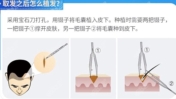 大麦微针植发价格费用表