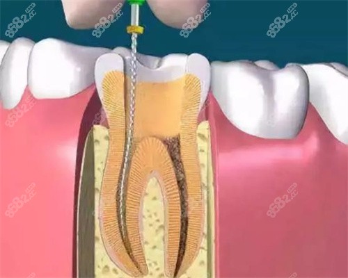 根管治疗后必须做牙冠吗？