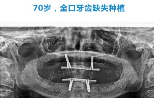 长沙牙祖口腔做70岁全口种植牙