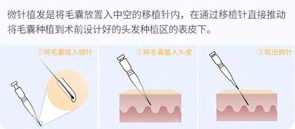 大麦微针植发价格区间10-60元之间