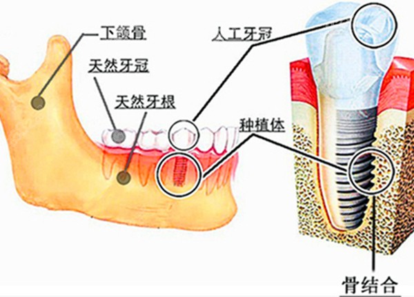 种植牙和天然牙的对比
