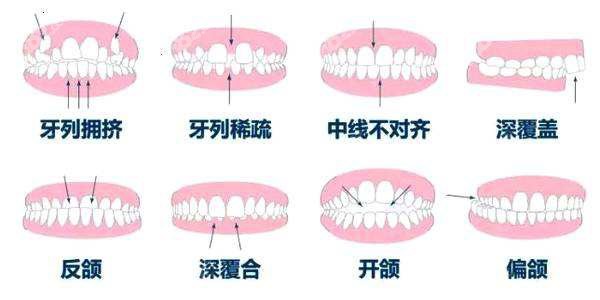 哪些牙怀况需做牙齿矫正