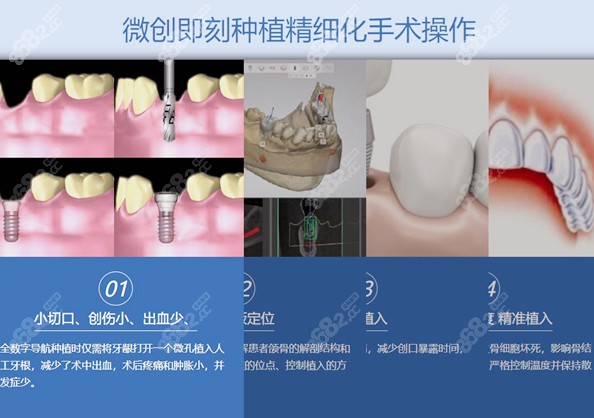 即刻种植的优点图