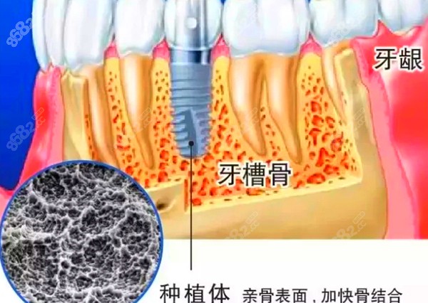 牙槽骨与植体的关系图