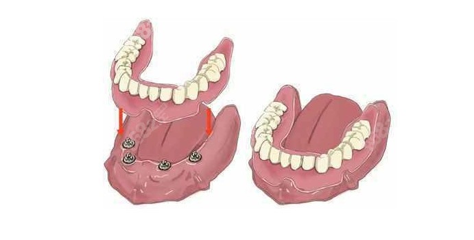 半固定种植假牙修复方式了解下